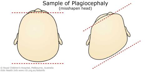 Sample of Plagiocephaly